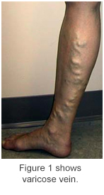 varicose vein