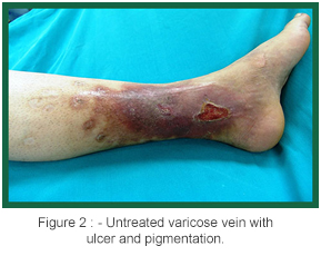 varicose vein